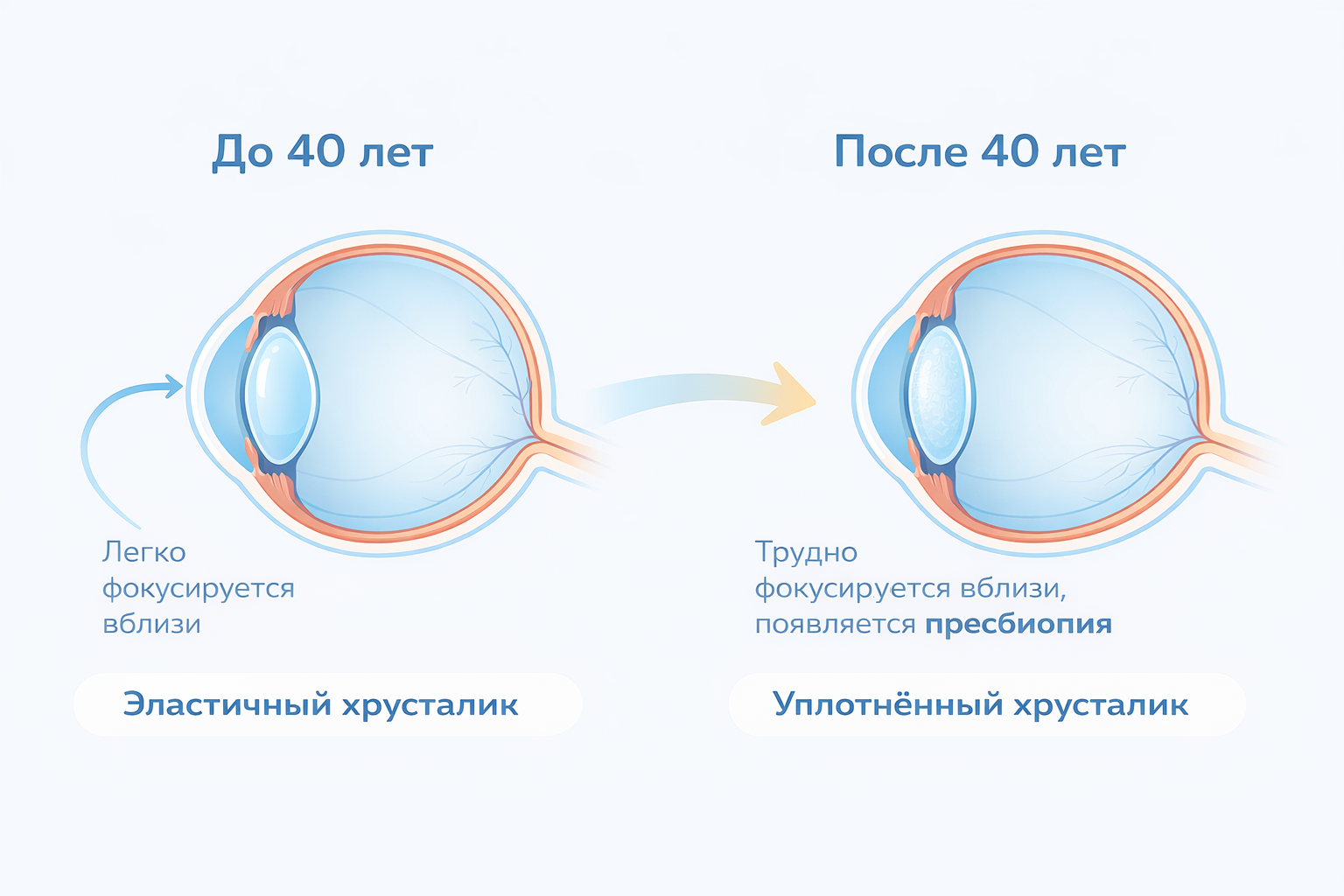 Изменения хрусталика с возрастом