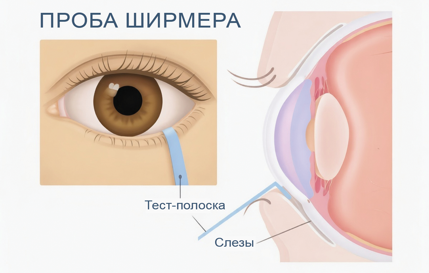 проба Ширмера для диагностики сухого глаза