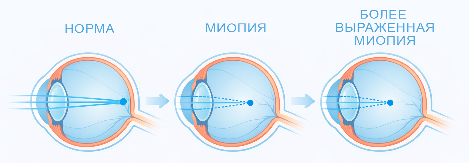 разная степень миопии