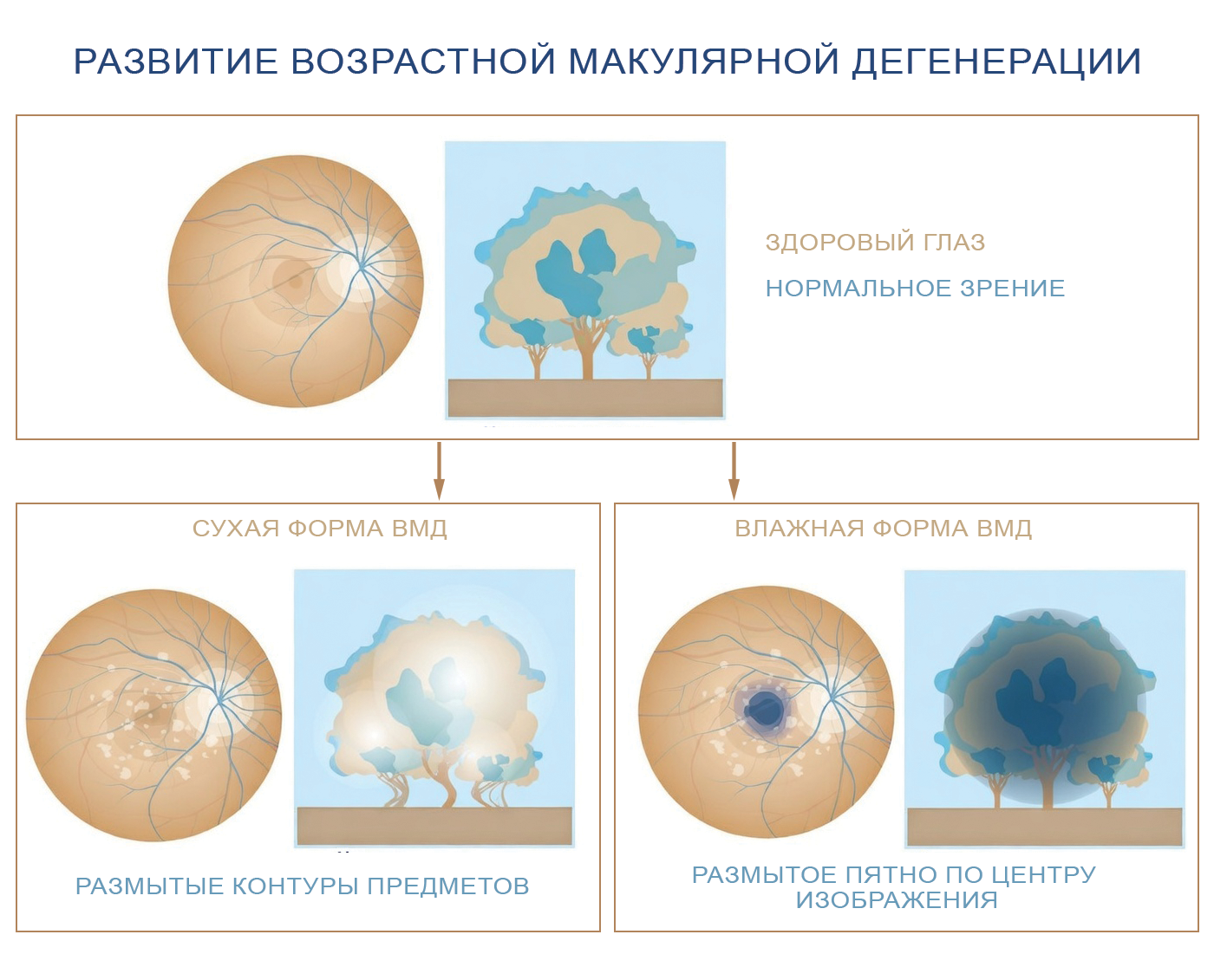сухая и влажная формы ВМД