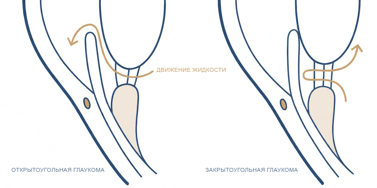 типы глаукомы