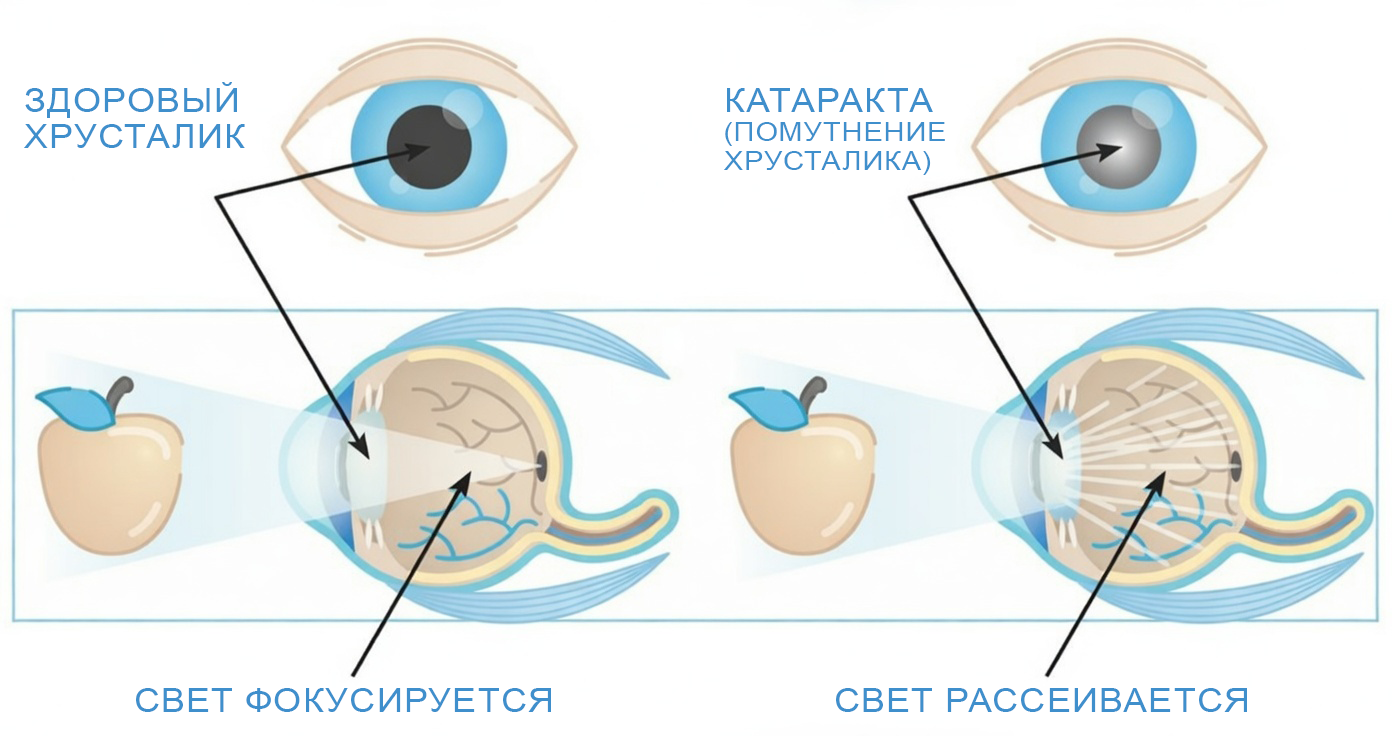 катаракта