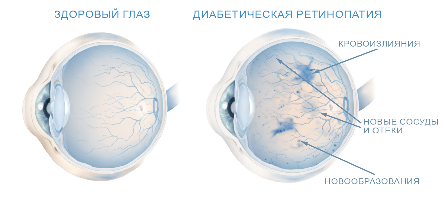 диабетическая ретинопатия