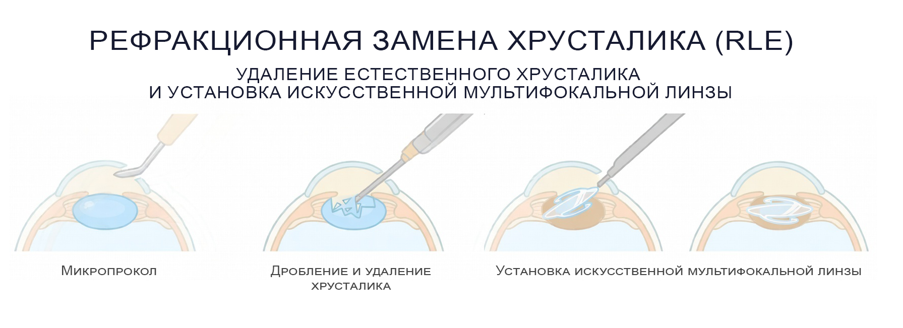 Этапы рефракционной замены хрусталика