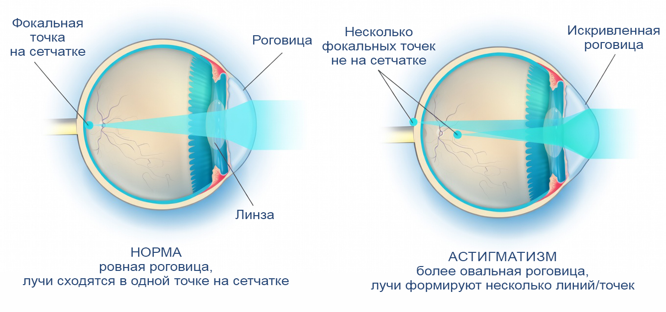 схема: норма и астигматизм