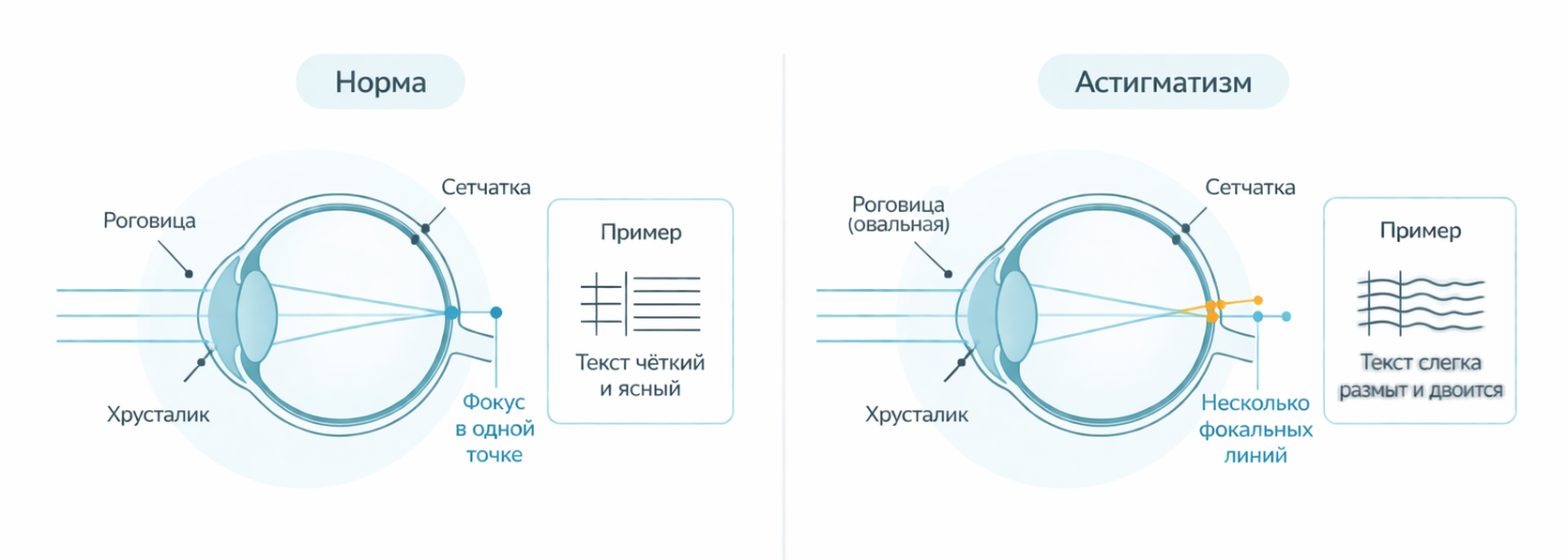 схема сравнения нормального зрения и зрения при астигматизме