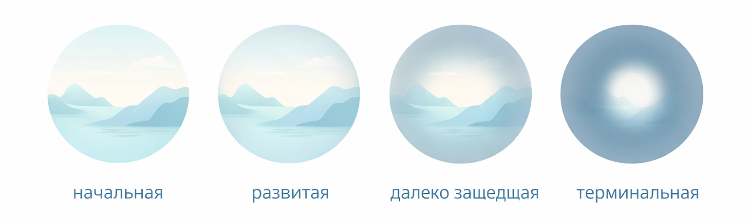 стадии потери зрения при глаукоме